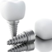 Ventajas de los implantes dentales en Madrid