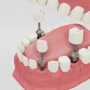 Implantes dentales Salamanca