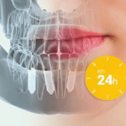 Implantes dentales sin dolor en Madrid