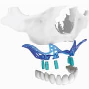 Implantes dentales sin tornillos precios