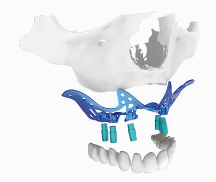 Implantes dentales sin tornillos precios