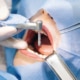 Implantes dentales inmediatamente después de la extracción: ¿ventajas o desventajas?