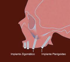 Implantes pterigoideos precio
