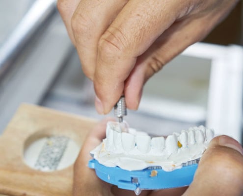 Las incrustaciones dentales tipo onlay
