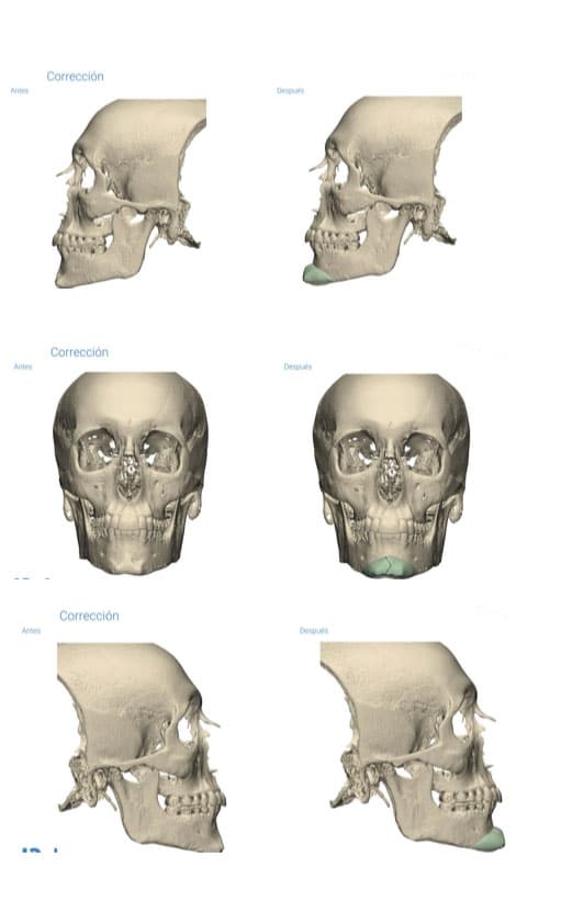 La customización de implantes llega a la cirugía facial