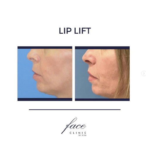 Lip Lift antes y después - caso 1