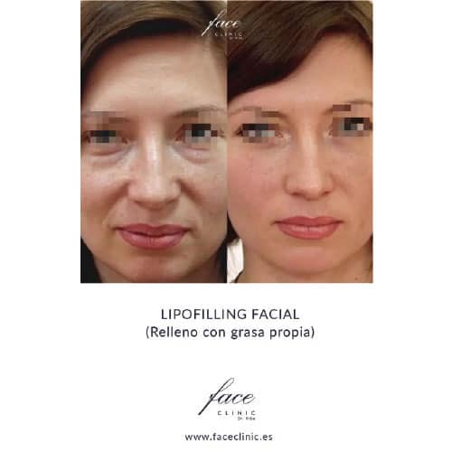 Lipofilling facial antes y después - Caso 2