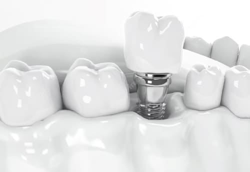 Mini implantes dentales precio