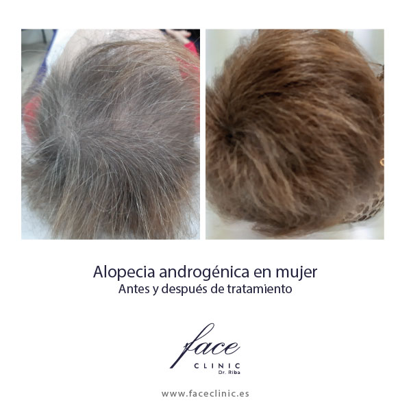 Mujeres con alopecia androgénica antes y después - caso 1