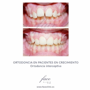 Ortodoncia interceptiva en niños