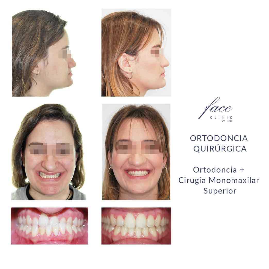 Ortodoncia quirúrgica antes y después