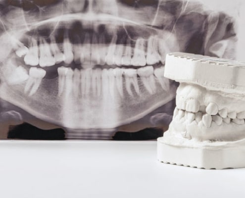 Osteotomia dental
