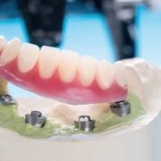 Prótesis dentales fijas hibridas