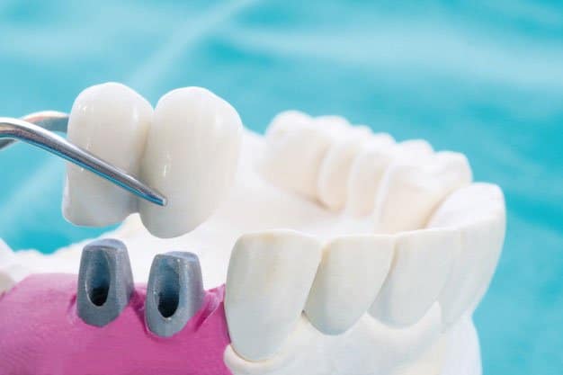 Puente dental o implante