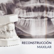 Reconstrución maxilar