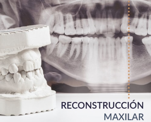 Reconstrucción maxilar en Madrid