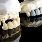 Rehabilitación del maxilar superior con implantes