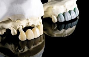 Rehabilitación del maxilar superior con implantes