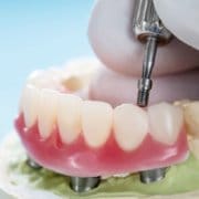 Sobredentadura sobre 4 implantes dentales